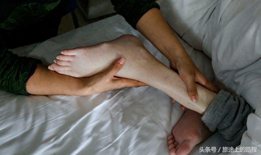 直击”骷髅男孩“一生，每天靠药物维持生活，亲戚建议“安乐死”