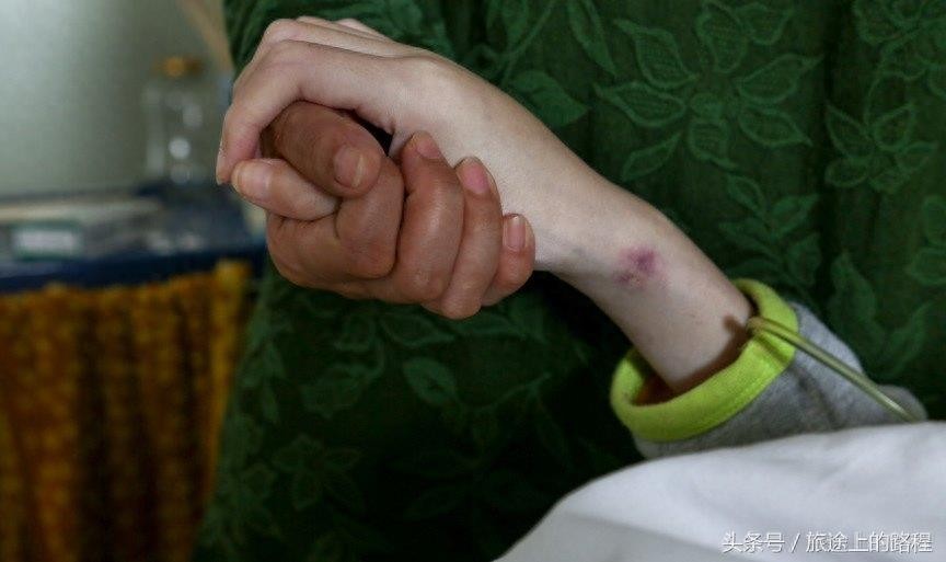 直击”骷髅男孩“一生，每天靠药物维持生活，亲戚建议“安乐死”