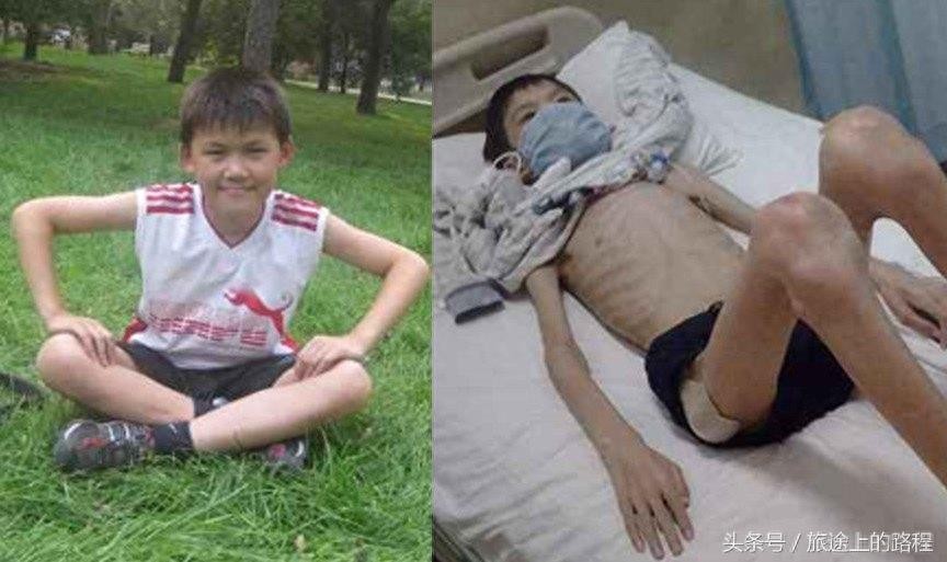 直击”骷髅男孩“一生，每天靠药物维持生活，亲戚建议“安乐死”