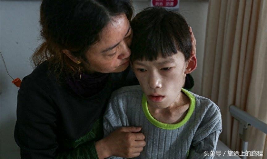 直击”骷髅男孩“一生，每天靠药物维持生活，亲戚建议“安乐死”