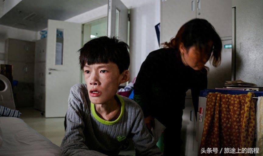 直击”骷髅男孩“一生，每天靠药物维持生活，亲戚建议“安乐死”