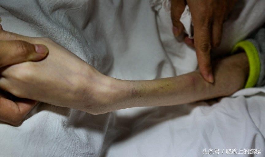 直击”骷髅男孩“一生，每天靠药物维持生活，亲戚建议“安乐死”